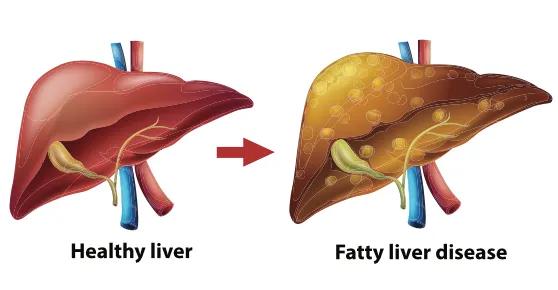 Managing Diabetes Correctly  Reduces Risk of Fatty Liver Disease