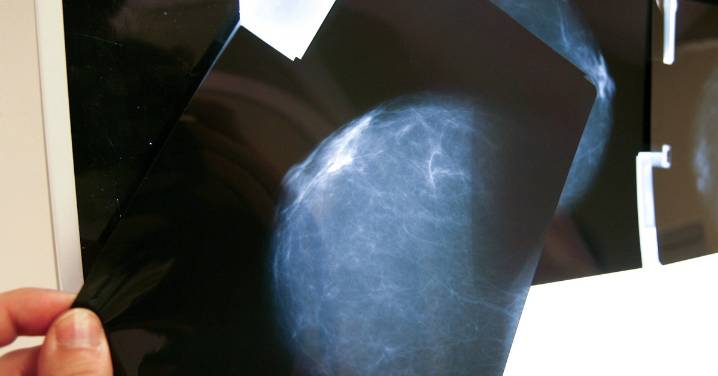 Expertos alertan sobre la falta de registros de cáncer de mamá en América Latina