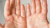 Highly Contagious Disease On The Rise