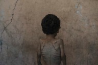 Nearly 55,000 children in Gaza under age 5 may be acutely malnourished, a new UN study finds