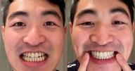 The best Prime Day tooth whitening deal saves £120 but isn't on Amazon