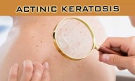 Bimiralisib Gel Shows Strong Efficacy for Early-Stage Actinic Keratosis in Phase 2 trial
