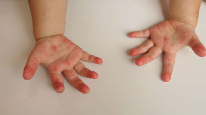 Warning issued over spike in hand, foot and mouth disease in Prince George’s schools