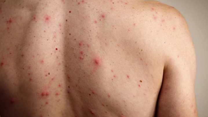 Más de 5 mil casos de sarampión son confirmados en México