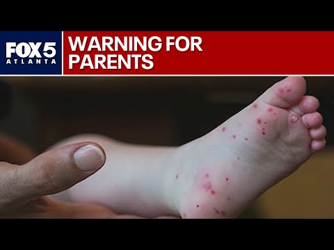Georgia sees sharp rise in contagious rash
