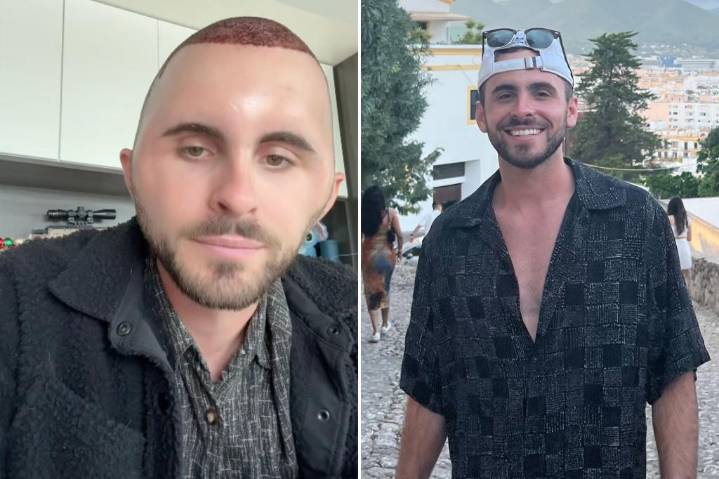 How a hair transplant at 27 left me looking 'like an egg'