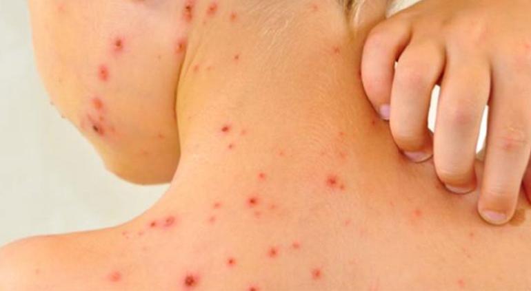 5,053 casos de sarampión en México durante 2025