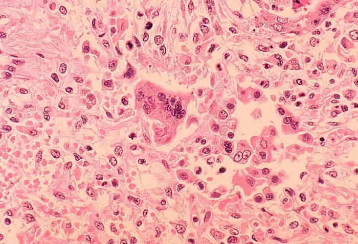 New map tracks measles exposures across Washington