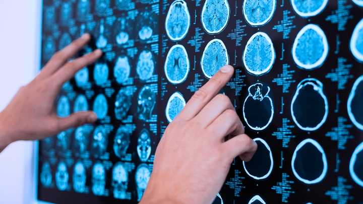 Aumentan los casos de encefalitis autoinmune, la enfermedad que ataca el cerebro de los jóvenes sin avisar