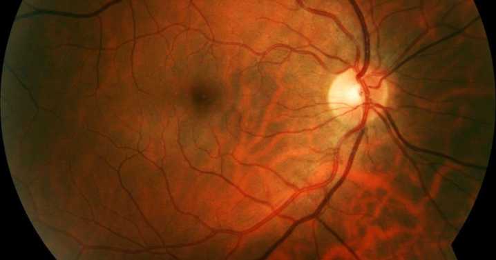 Ceguera irreversible: científicos logran que pacientes vuelvan a ver gracias a un chip ocular
