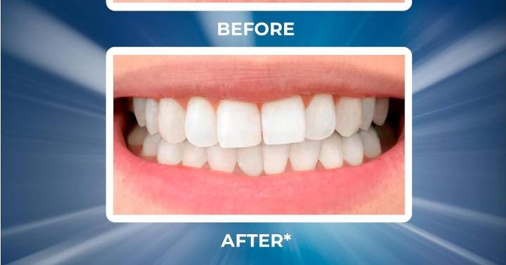 'My teeth are much brighter' - Amazon shoppers rave over £8 whitening strips