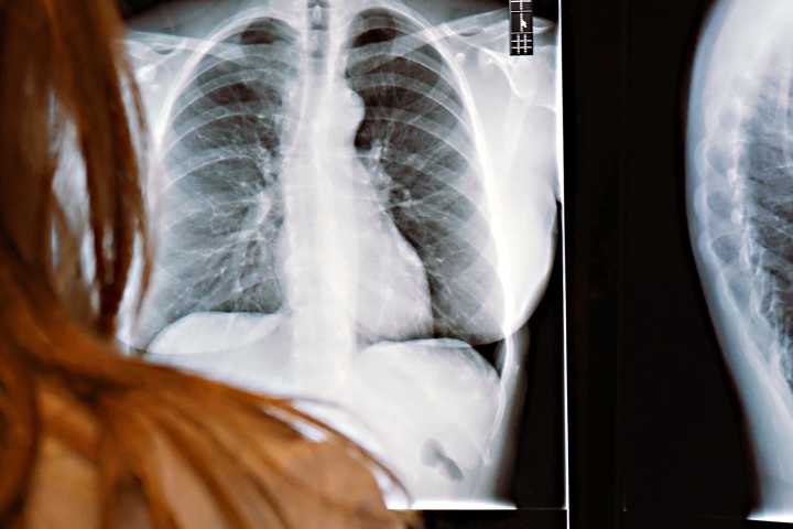 Al año hay cerca de 300 casos confirmados de tuberculosis, en Baja California Sur 