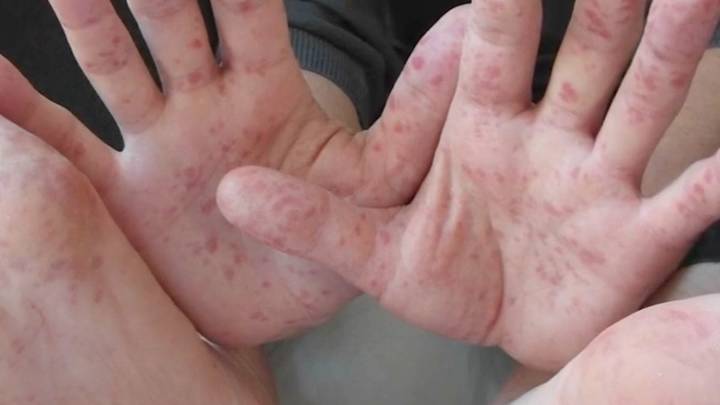 Atienden brotes de Coxsackie; reportan contagios en múltiples escuelas de Saltillo