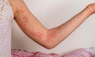FDA Approves Oral Remibrutinib as First BTK Inhibitor for Chronic Spontaneous Urticaria
