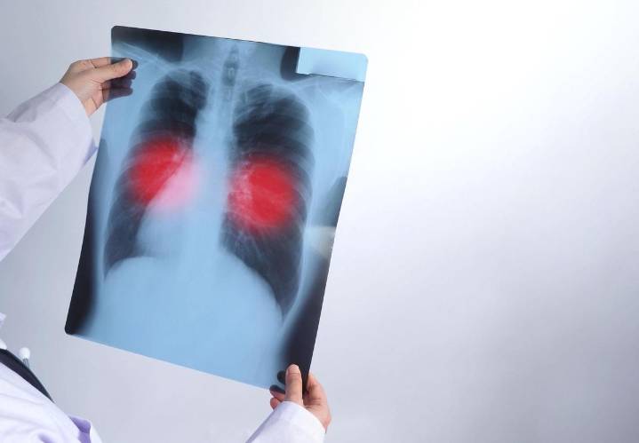 PGIMER Flags Rise in Rare Chest Infections in North India