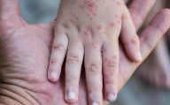 Saltillo: Secretaría de Salud dictaminará posible brote de coxsackie en el Colegio Nicolás Bravo