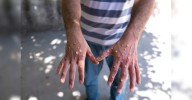 California mpox cases raise concerns. But health officials say the risk remains low