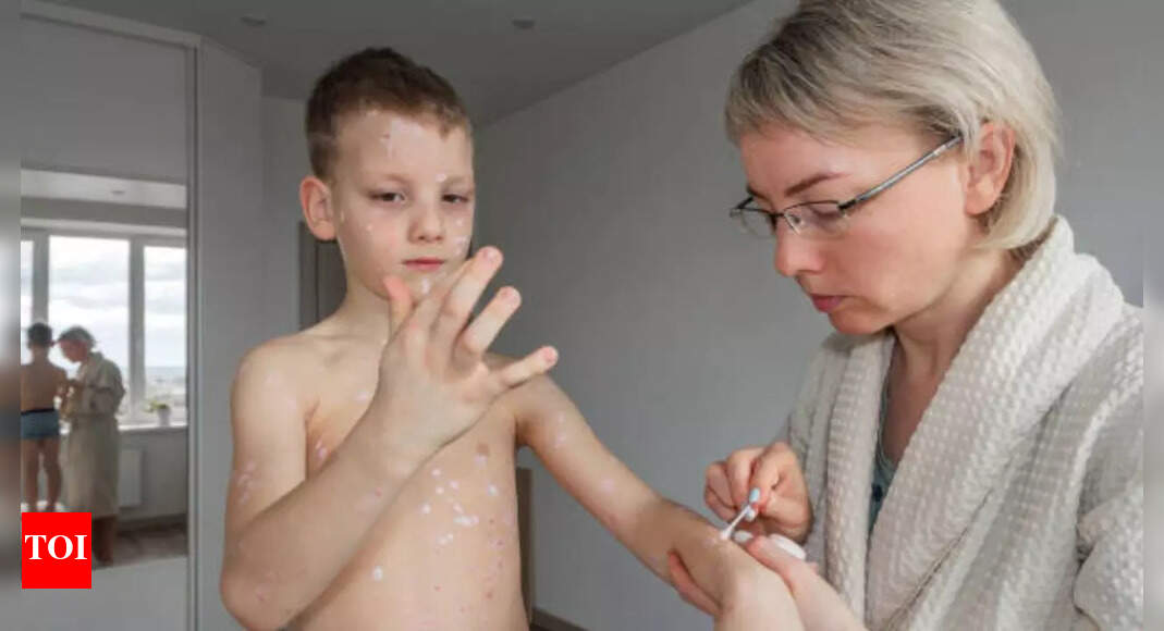 Measles Outbreak: Why measles is spreading in the US - and Utah-Arizona border is the new hotspot