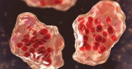 Olmsted County health officials confirm new measles case