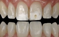 Silica Particle Size and Concentration Critically Influence Dental Resin Performance: Study