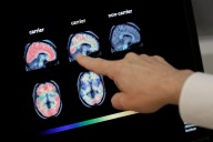 Voters like candidates supporting war on Alzheimer's: Poll