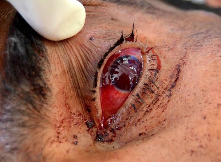 14 Children Blinded, 120 Injured After Playing with Carbide Guns on Diwali Eve