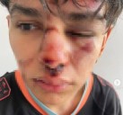 CASTELLI: Joven Fue Brutalmente Golpeado A La Salida De Un Evento Bailable