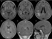 1 in 3 people worldwide affected by brain-related conditions: WHO sounds alarm