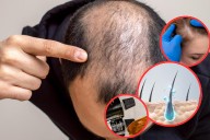 Nuevo gel estimula el crecimiento capilar hasta en un 90 %, según estudio científico