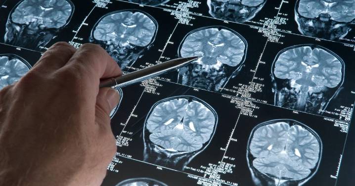 Denuncian dificultades de acceso a nuevas terapias para el glioblastoma