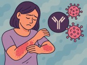 Desinformación y estigma retrasan el diagnóstico de psoriasis en México