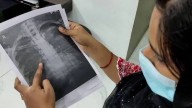 Guide wire left in woman's chest during surgery; Police to form special medical board
