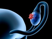 Coagulation Factor II Receptor Shows Promise as Ovarian Cancer Target