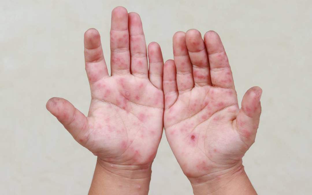 Alerta sanitaria: Suman 17 casos de virus coxsackie en Centro Escolar de Izúcar