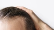 Ramón Grimalt, dermatólogo, sobre la calvicie: "En cuatro años no quedará ni un solo cabello de los que tienes"