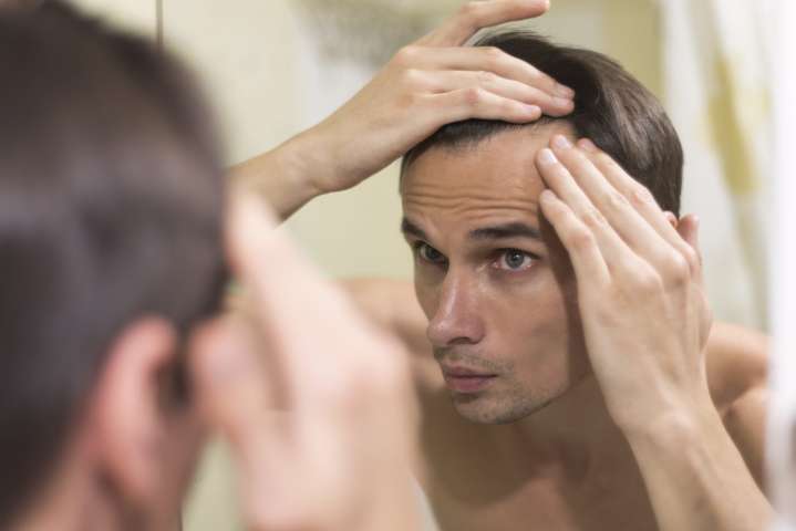 Este edulcorante podría potenciar los efectos de un conocido fármaco para la alopecia