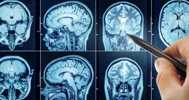 Cerebro de los hombres se encoge más rápido que el de las mujeres, revela un estudio