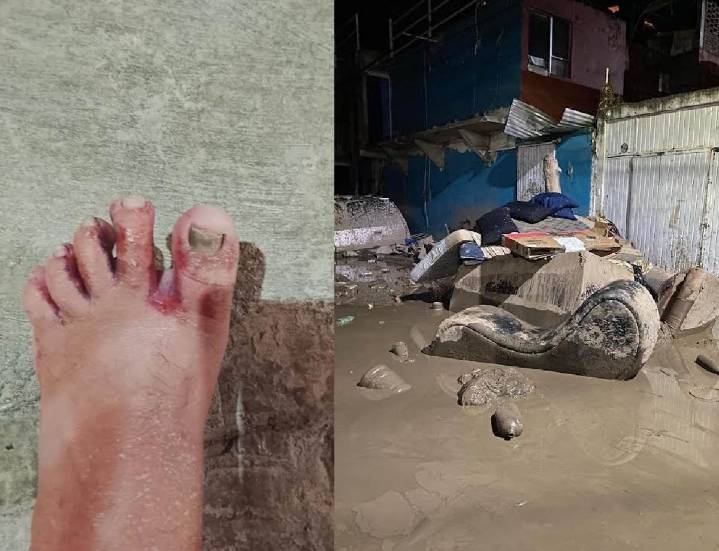 Pobladores de Poza Rica, Veracruz, presentan afectaciones dermatológicas tras estragos de las lluvias