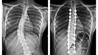 Mumbai News: 16-Year-Old Schoolgirl Gains Confidence After Complex Scoliosis Surgery At Wockhardt Hospitals