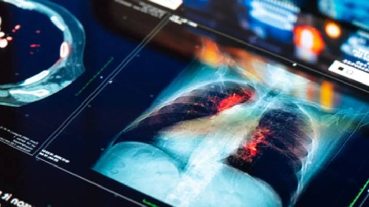 Why Lung Screening Matters