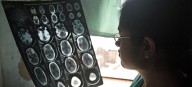 Más de once millones de personas mueren cada año por trastornos neurológicos