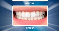 'My teeth are much brighter' - Amazon shoppers rave over £8 whitening strips