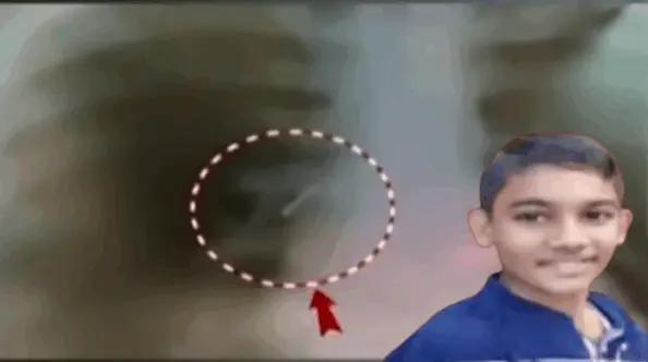 Class 7 Student Dies 10 Days After Swallowing Pin In Odisha, Parents Blame School