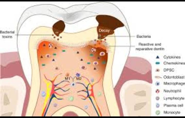 Partial Radicular Pulpotomy Viable Treatment for Symptomatic Irreversible Pulpitis in Mature...