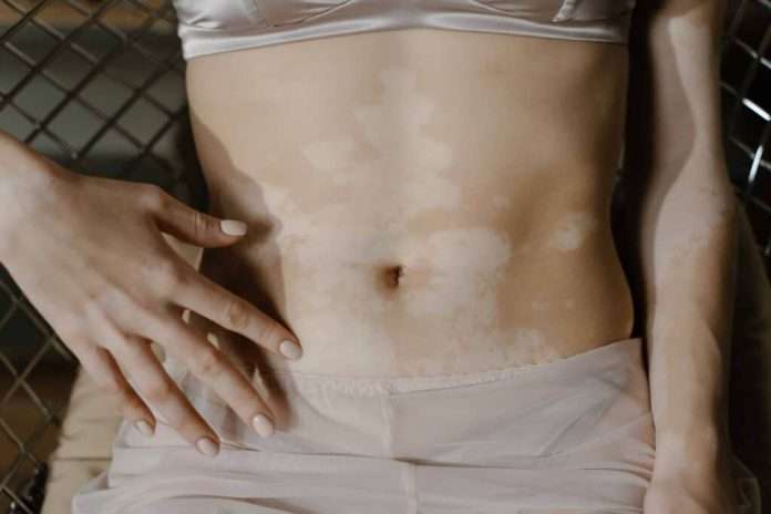 Obesidad abdominal podría estar vinculada al desarrollo de vitíligo