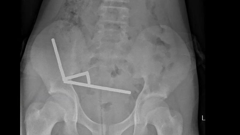 13-year-old boy hospitalized after swallowing dozens of high