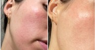 What Is Contact Dermatitis? Skin Tips From a Dermatologist