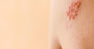 Shingles Vax Protects Against Heart Disease, Dementia, Death