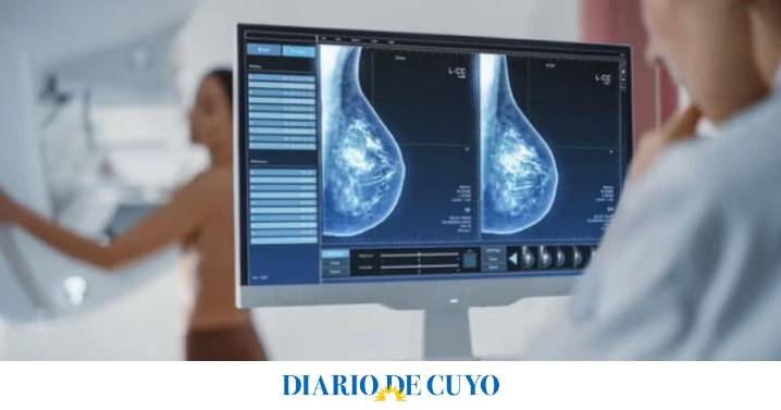 Cáncer de mama: cambian la edad en la que se debe hacer la primera mamografía