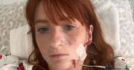 'My face became paralysed after drinking tea – now I have to tape eyes shut to sleep'